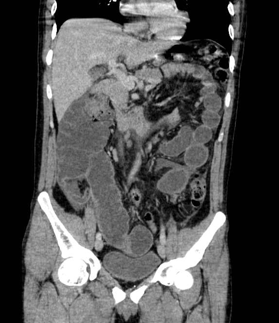 Bowel obstruction from colon carcinoma (Radiopaedia 22995-23028 C 33).jpg