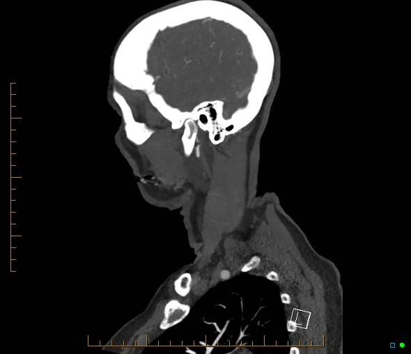 Brachiocephalic trunk stenosis (Radiopaedia 87242-103519 C 10).jpg
