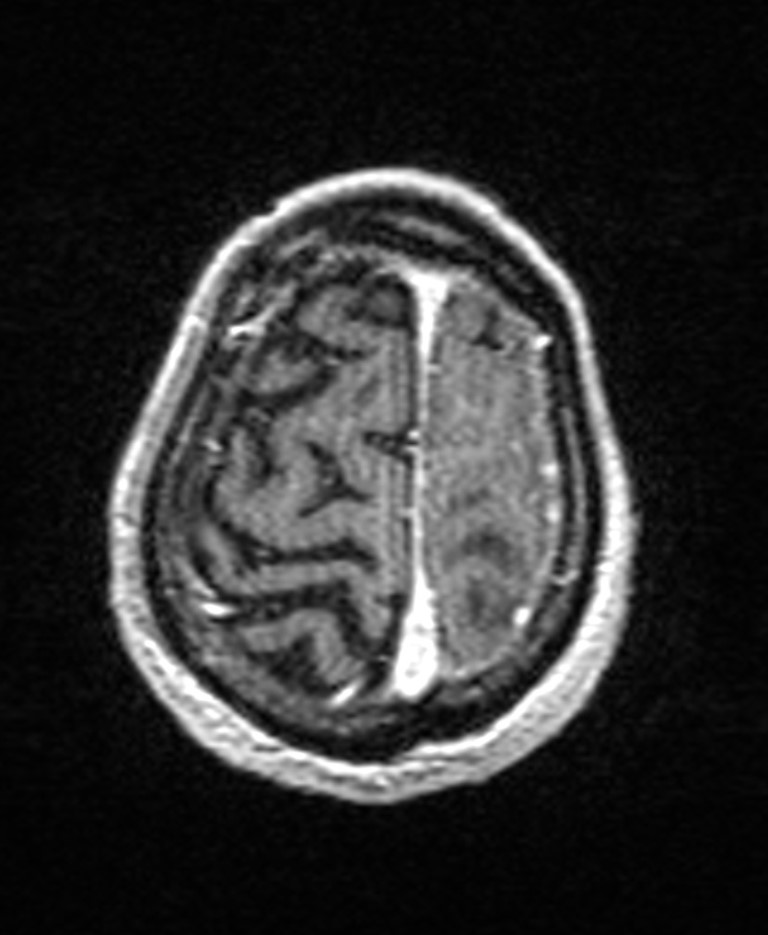 Brain abscess with dual rim sign (Radiopaedia 87566-103938 Axial T1 C+ 141).jpg