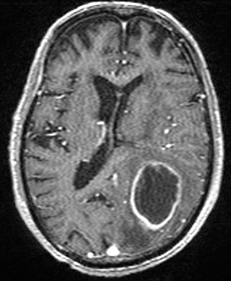 Brain abscess with dual rim sign (Radiopaedia 87566-103938 Axial T1 C+ 95).jpg