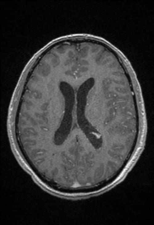 Brain abscess with ventriculitis (Radiopaedia 85703-101495 Axial T1 C+ 107).jpg
