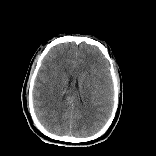 File:Brain contusions, internal carotid artery dissection and base of skull fracture (Radiopaedia 34089-35339 Axial non-contrast 33).png