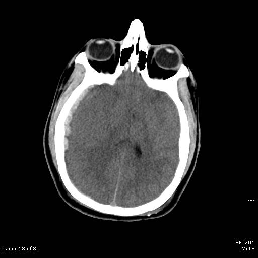 File:Brain death after motor vehicle collision (Radiopaedia 88470-105114 Axial non-contrast 18).jpg