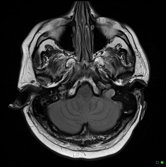 File:Brain death on MRI and CT angiography (Radiopaedia 42560-45689 Axial FLAIR 4).jpg