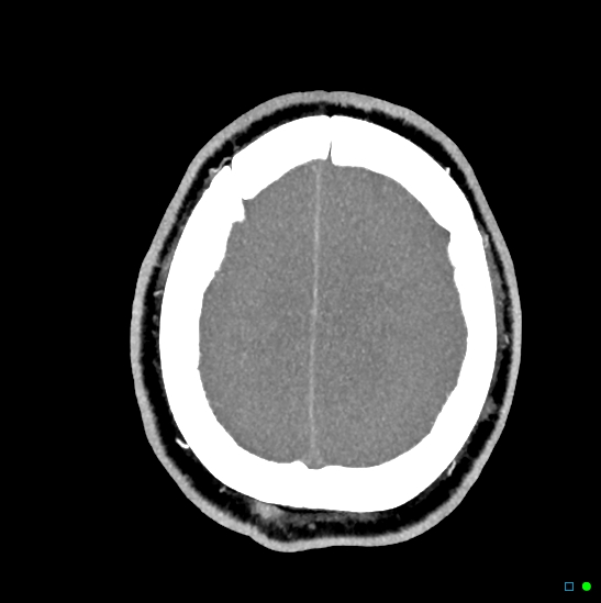 Brain death on MRI and CT angiography (Radiopaedia 42560-45841 B 11).jpg