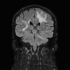 Brain metastases from lung cancer (Radiopaedia 83839-99028 Coronal FLAIR 49).jpg