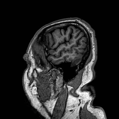 Brain metastases from lung cancer (Radiopaedia 83839-99028 Sagittal T1 12).jpg