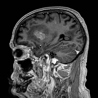 Brain metastases from lung cancer (Radiopaedia 83839-99028 Sagittal T1 C+ 19).jpg