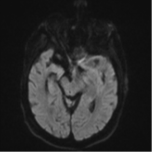 Brain metastasis (lung cancer) (Radiopaedia 48289-53179 Axial DWI 39).png