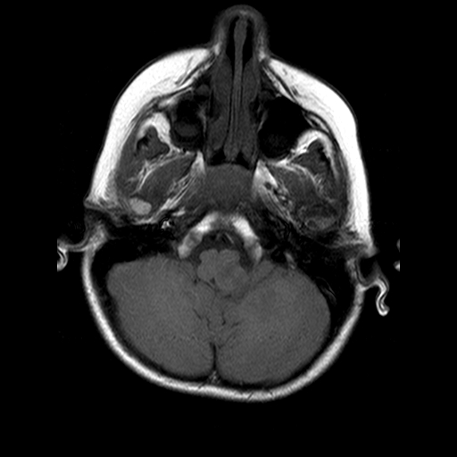 File:Brainstem ganglioglioma (Radiopaedia 10763-11224 Axial T1 16).jpg
