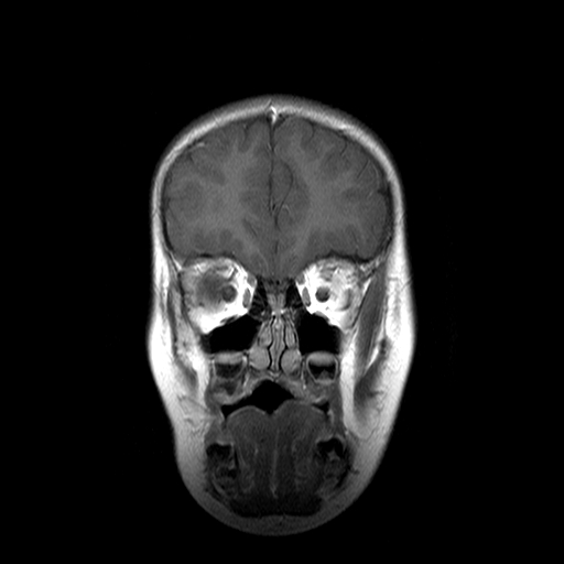 File:Brainstem ganglioglioma (Radiopaedia 10763-11224 Coronal T1 C+ 16).jpg