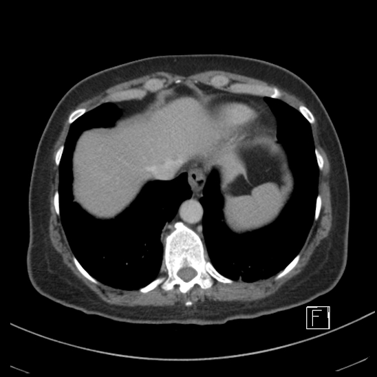 Breast metastases from renal cell cancer (Radiopaedia 79220-92225 C 8).jpg