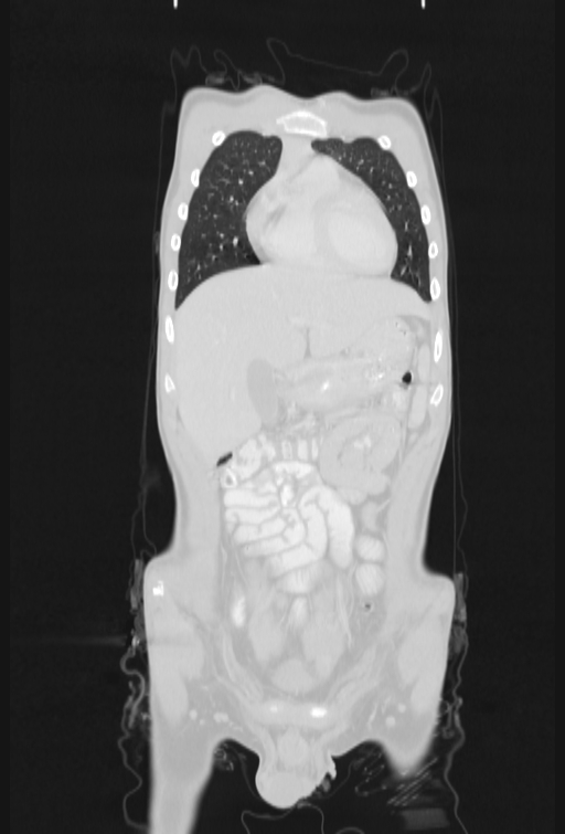Bronchial carcinoid tumor (Radiopaedia 57187-64090 Coronal lung window 19).jpg