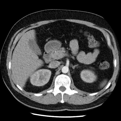 Bronchial carcinoid tumor (Radiopaedia 67377-76764 A 67).jpg