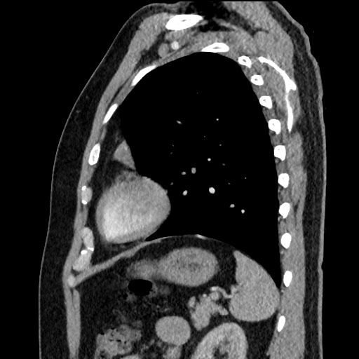 Bronchial carcinoid tumor (Radiopaedia 67377-76764 E 52).jpg