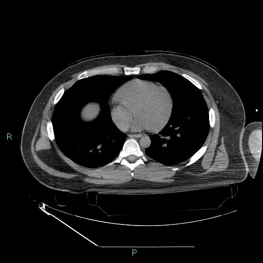 Bronchial carcinoid tumor (Radiopaedia 78272-90870 Axial non-contrast 66).jpg