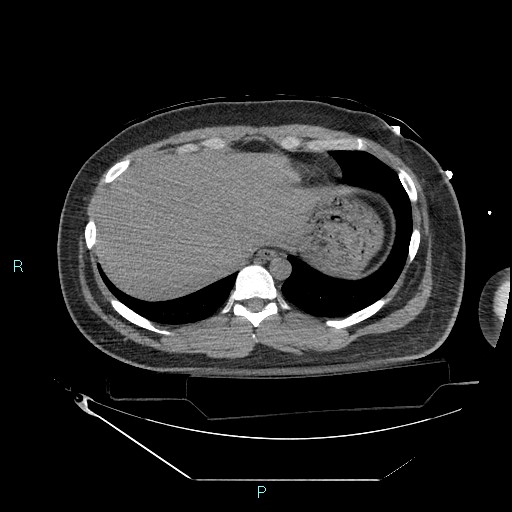 Bronchial carcinoid tumor (Radiopaedia 78272-90870 Axial non-contrast 88).jpg