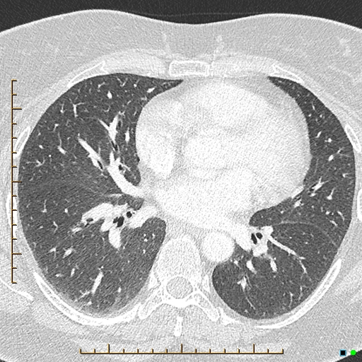 File:Bronchial diverticula (Radiopaedia 79512-92676 Axial lung window 110).jpg