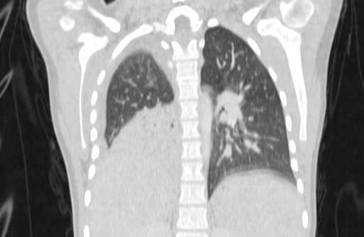 Bronchial mucoepidermoid carcinoma (Radiopaedia 57023-63895 Coronal lung window 54).jpg
