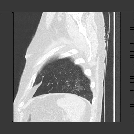Bronchial stenosis - lung transplant (Radiopaedia 73133-83848 Sagittal lung window 61).jpg