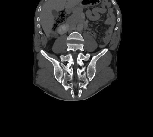 Bronchiectasis in Crohn disease (Radiopaedia 60311-67977 Coronal bone window 45).jpg