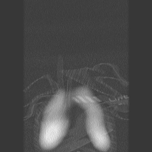 File:Bronchiolotis obliterans (Radiopaedia 73769-84575 Coronal lung window 1).jpg