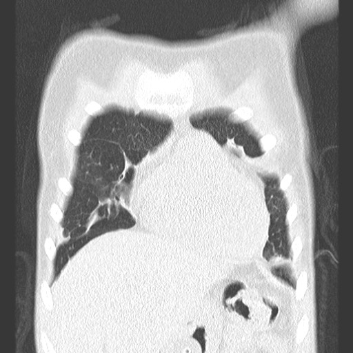 File:Bronchiolotis obliterans (Radiopaedia 73769-84575 Coronal lung window 10).jpg