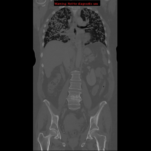 File:Bronchoalveolar carcinoma (Radiopaedia 13224-13233 Coronal non-contrast 13).jpg