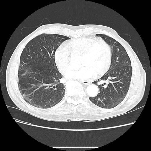 Bronchocele (Radiopaedia 17097-16795 Axial lung window 77).jpg