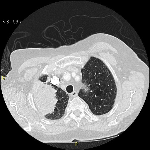 Bronchogenic carcinoma as an incidental finding (Radiopaedia 16453-16130 Axial lung window 96).jpg