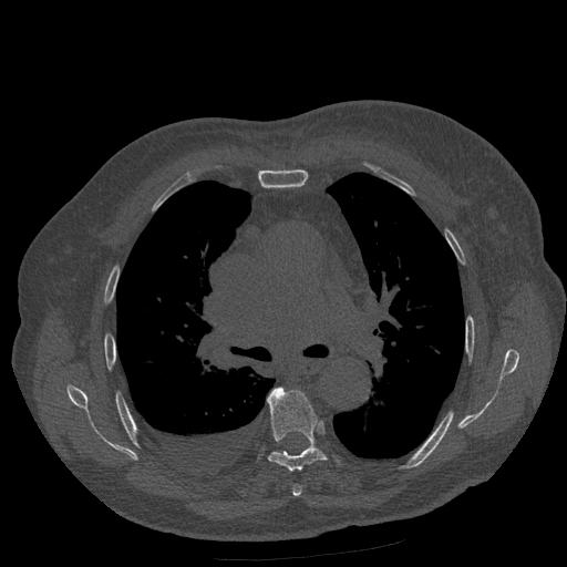 Bronchogenic carcinoma with metastatic lymphadenopathy (Radiopaedia 37671-39569 Axial bone window 24).jpg