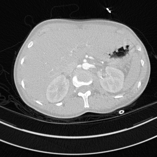 Bronchogenic cyst (Radiopaedia 77801-90071 Axial lung window 91).jpg