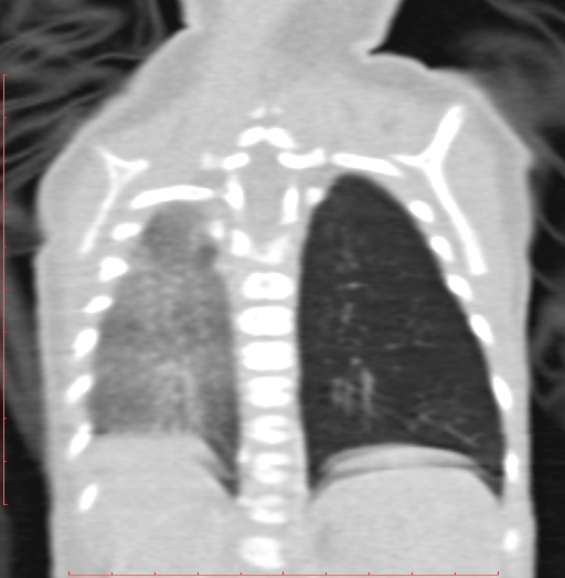 Bronchogenic cyst (Radiopaedia 78599-91409 Coronal lung window 173).jpg