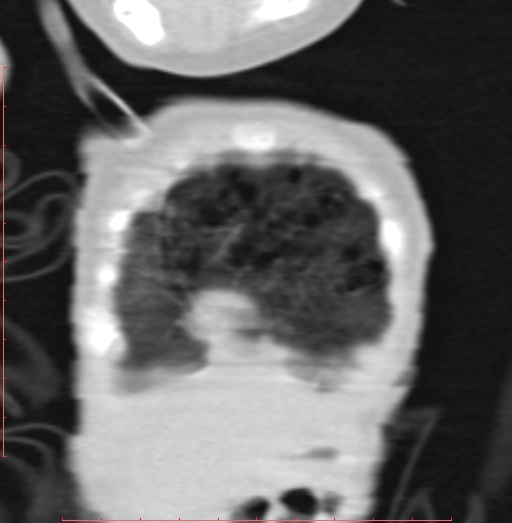 Bronchogenic cyst (Radiopaedia 78599-91409 Coronal lung window 26).jpg