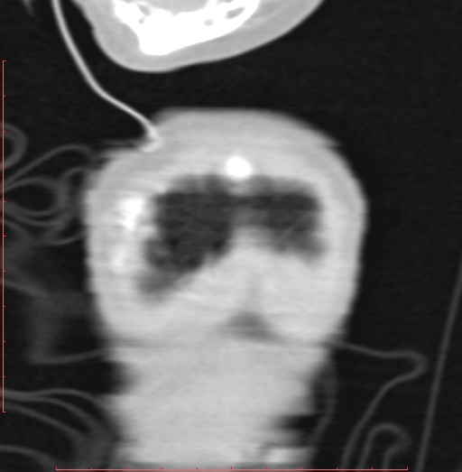 File:Bronchogenic cyst (Radiopaedia 78599-91409 Coronal lung window 7).jpg