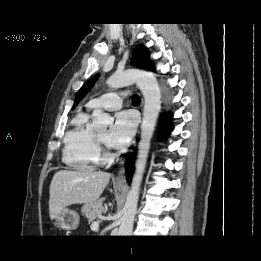 Bronchogenic cyst - posterior mediastinal (Radiopaedia 43885-47364 B 47).jpg
