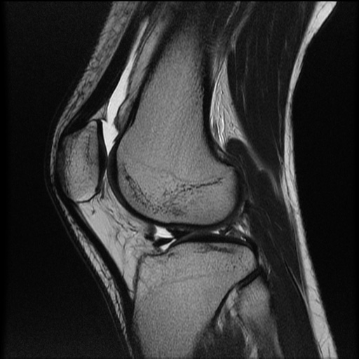 File:Bucket-handle meniscus tear (Radiopaedia 65700-74809 Sagittal T2 17).jpg