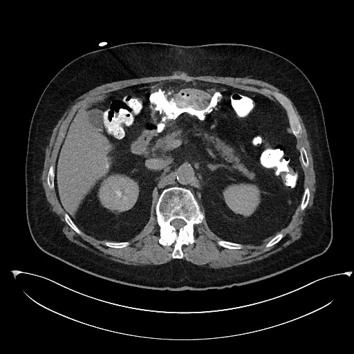 File:Buried bumper syndrome - gastrostomy tube (Radiopaedia 63843-72577 Axial Inject 32).jpg
