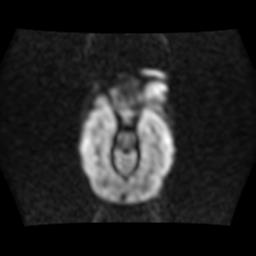 File:Burkitt lymphoma of the orbit- pre and post chemotherapy (Radiopaedia 31214-31929 Axial DWI 5).jpg