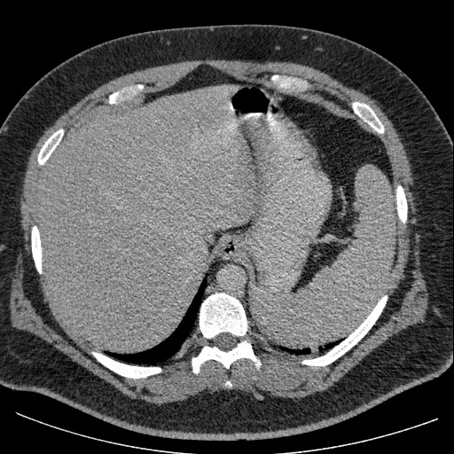 Burned-out testicular seminoma - retroperitoneal nodal metastases (Radiopaedia 62872-71245 A 13).jpg