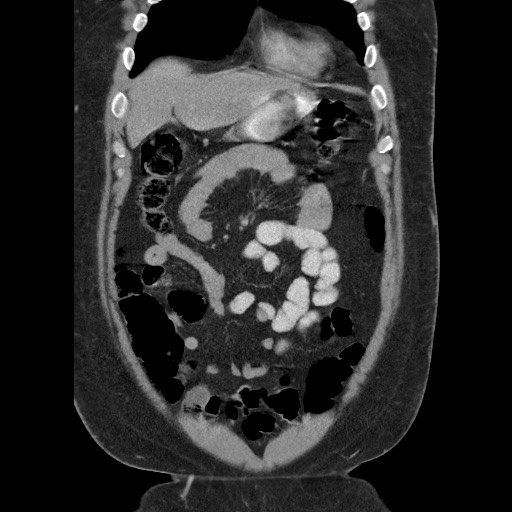 Burned-out testicular seminoma - retroperitoneal nodal metastases (Radiopaedia 62872-71245 B 18).jpg