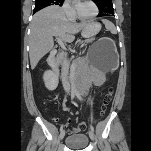 Burned-out testicular seminoma - retroperitoneal nodal metastases (Radiopaedia 62872-71245 B 33).jpg