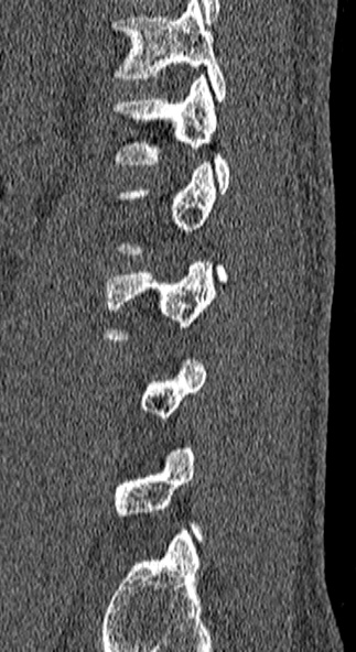 File:Burst fracture (Radiopaedia 53373-59357 Sagittal bone window 13).jpg