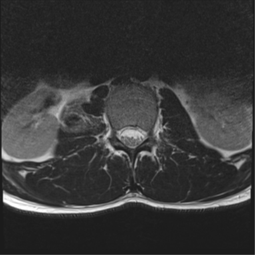 File:Burst fracture - T12 with conus compression (Radiopaedia 56825-63646 Axial T2 6).png