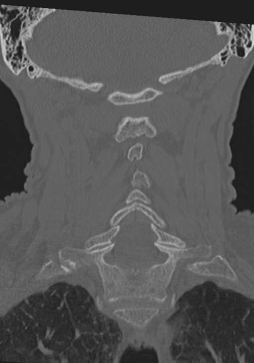 C2 fracture with vertebral artery dissection (Radiopaedia 37378-39199 Coronal bone window 31).png