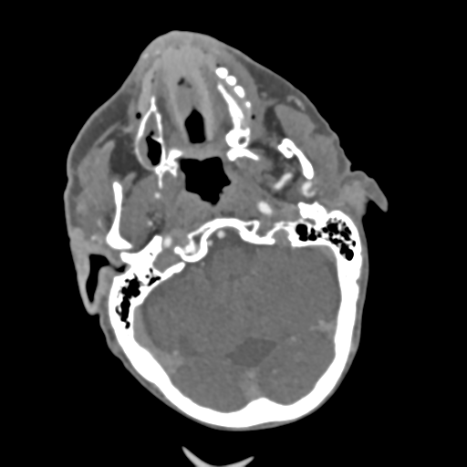 C2 fracture with vertebral artery dissection (Radiopaedia 37378-39200 A 198).png