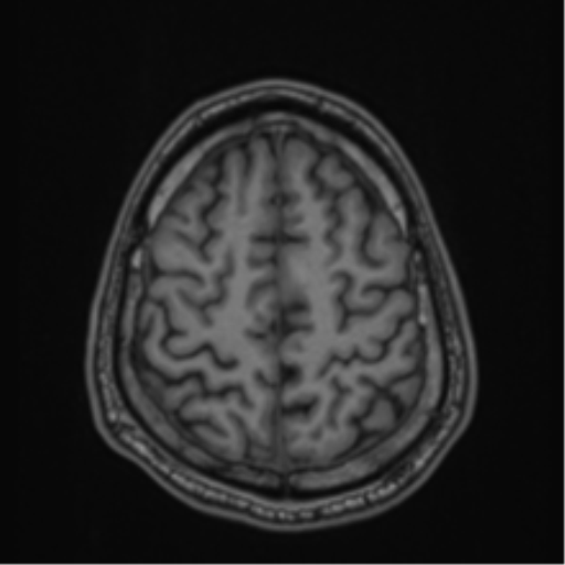 CNS vasculitis (Radiopaedia 55715-62263 Axial T1 79).png
