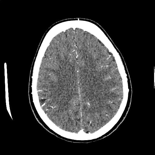 Calcified cerebral hydatid cyst (Radiopaedia 65603-74717 Axial with contrast 55).jpg