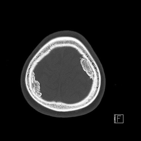Calcified chronic subdural hematoma (Radiopaedia 77374-89492 Axial bone window 124).jpg