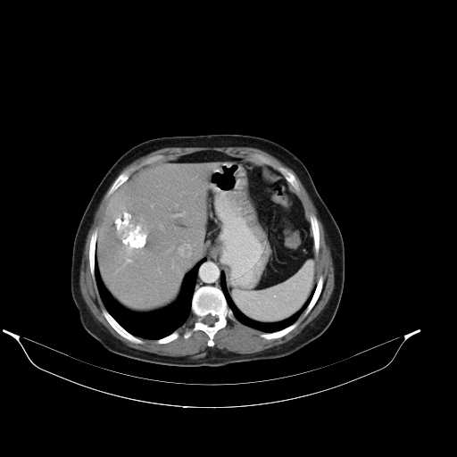 File:Calcified hydatid cyst of the liver (Radiopaedia 21212-21112 A 6).jpg